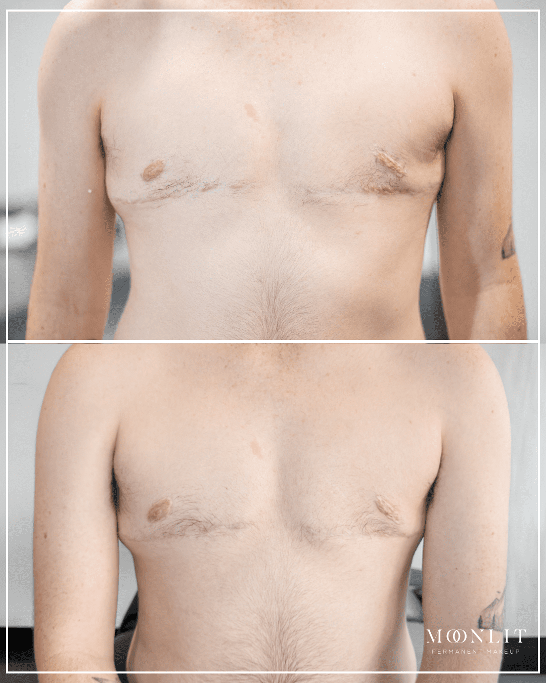 Before and after top surgery scar camouflage showing trans masculine chest with visible red, raised scars softened to more natural skin tone, improved blending and reduced contrast across chest, paramedical tattooing results in Salt Lake City, Utah