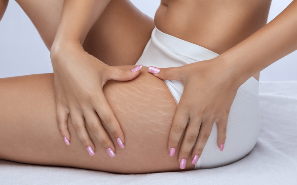 Client gently holding thigh with visible white stretch marks before camouflage treatment, natural skin texture and tone, paramedical tattooing focus, soft studio lighting, Salt Lake City, Utah