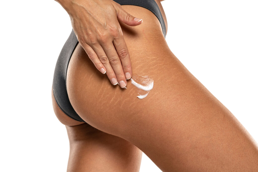 stretch mark camouflage preparation on upper thigh with visible stretch marks and skin care application before paramedical tattoo treatment in Salt Lake City Utah