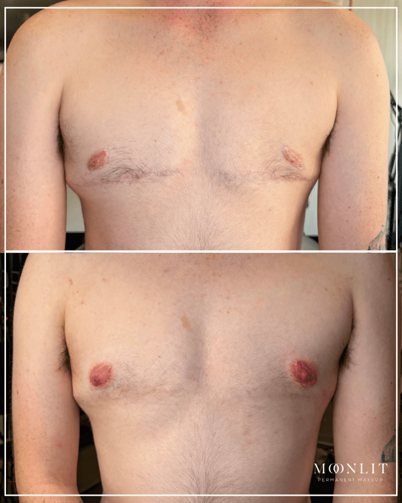 Before and after trans masculine top surgery chest showing healed surgical scars and restored areola color using paramedical tattooing, gender affirming PMU results with natural pigment blending, emotional confidence restoration, clinical studio setting, Salt Lake City, Utah and nationwide clientele